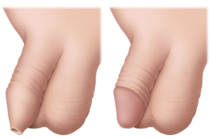The image of circumcision before and after