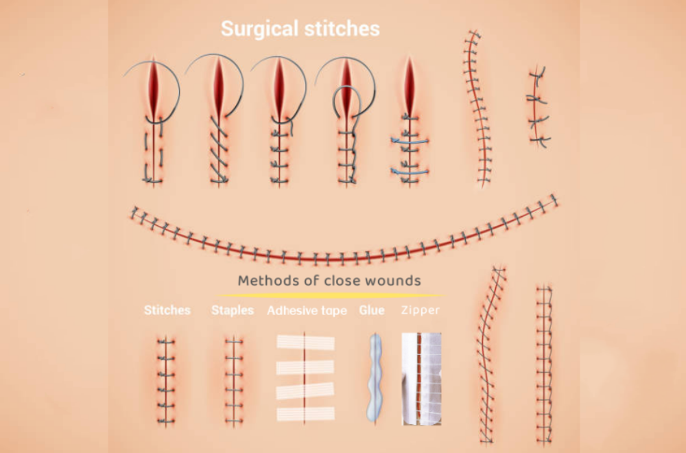 Skin Adhesives (Liquid Stitches)