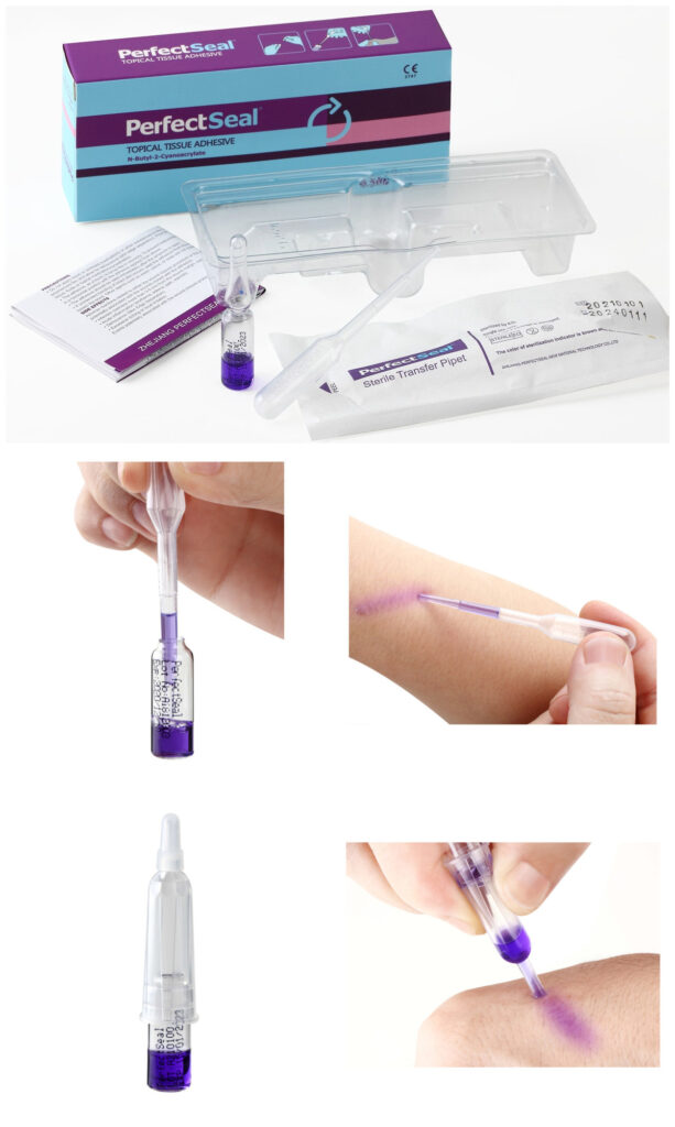 Dermabond liquid adhesive providing hemostasis to a child's