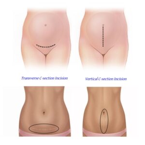 C-Section (Cesarean Section): Everything you need to know - PerfectSeal