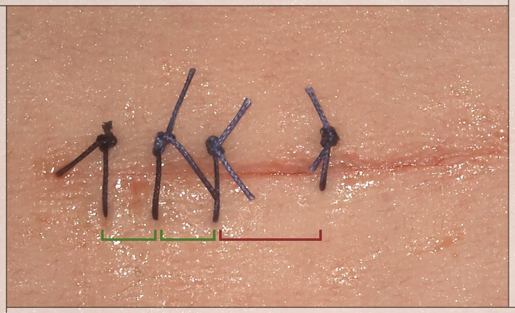 Simple Interrupted Suture Technique
