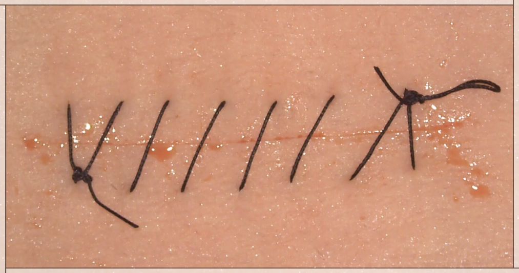 Simple Running Suture Technique