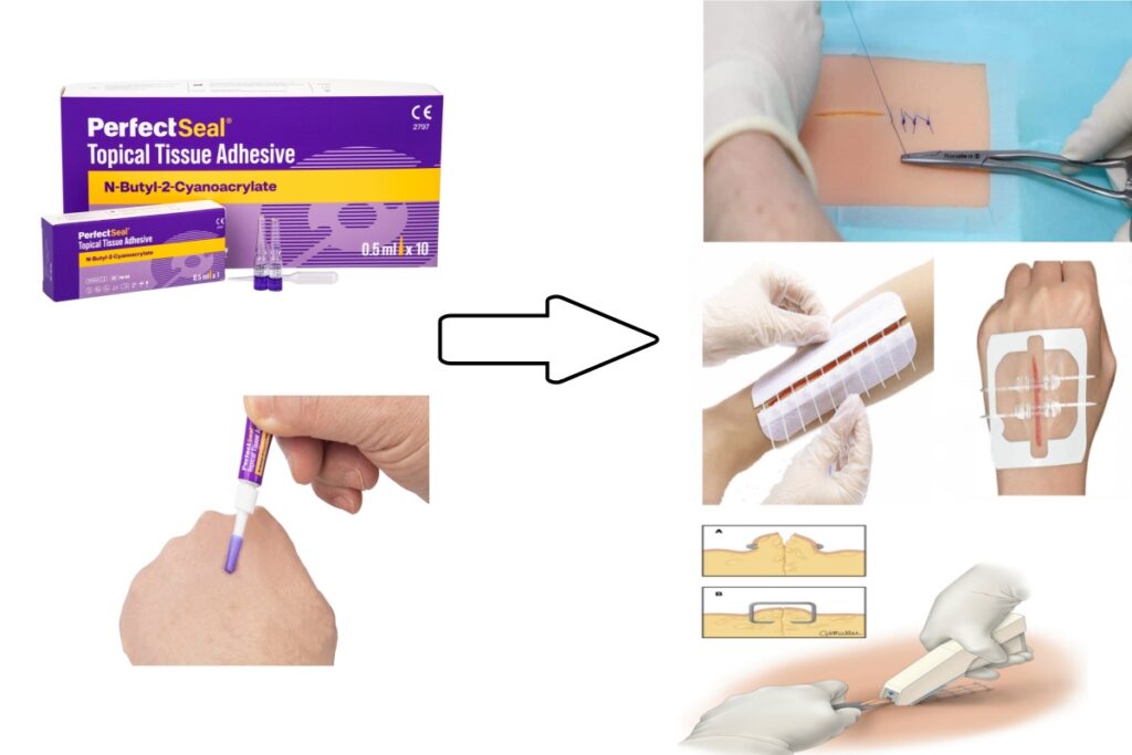 The image of skin tissue glue can be used in conjunction with regular sutures, staples, surgical zipper stitches, and subcutaneous tension sutures