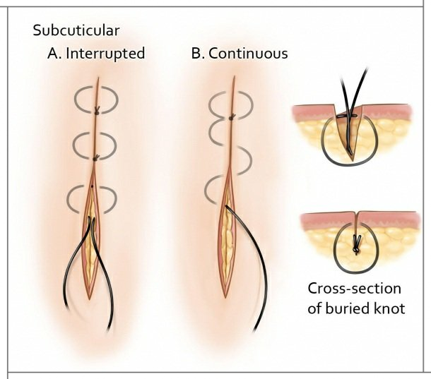 Subcuticular Suture Technique