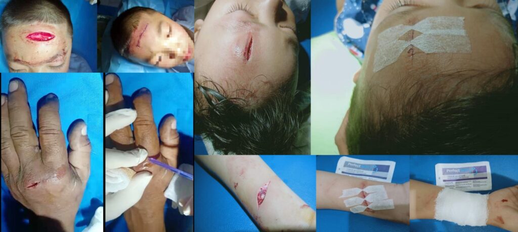 The image of use PerfectSeal tissue adhesive to seal wounds