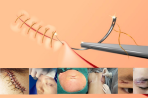 The image of types of Suture Techniques: Traditional VS Cosmetic Methods