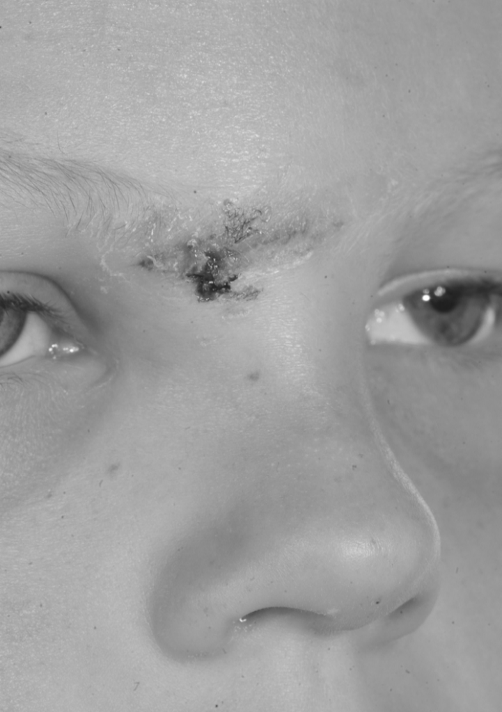 The picture of the right brow showing the glued wound