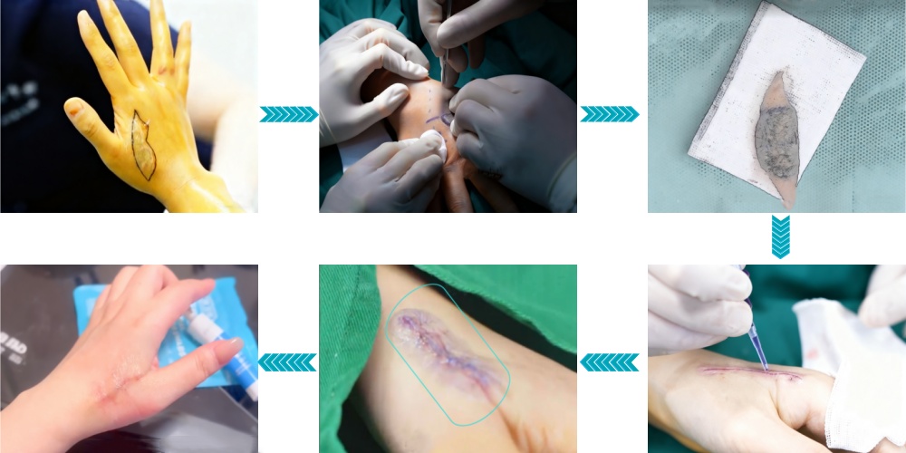 Surgical excision thumb and index finger tattoo removal steps