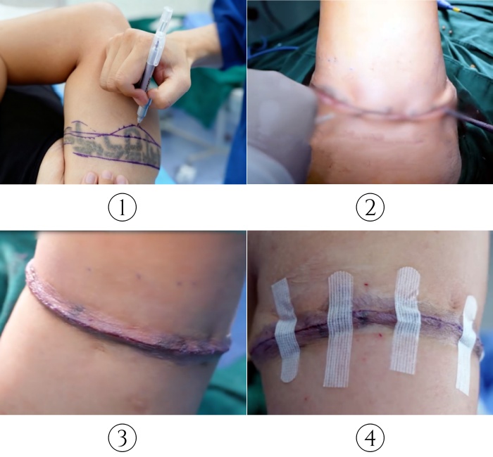 The wound from the removal of the upper arm circular tattoo is closed with a skin adhesive