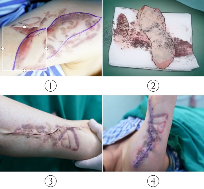 Using wound skin adhesive to close the upper arm tattoo removal's wound