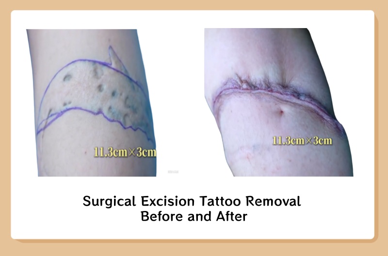 Tattoo Removal: Everything you need to know