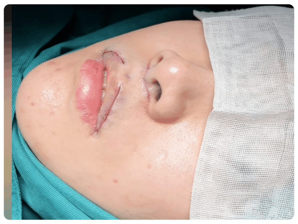 After philtrum shortening and lip vermilion border lifting