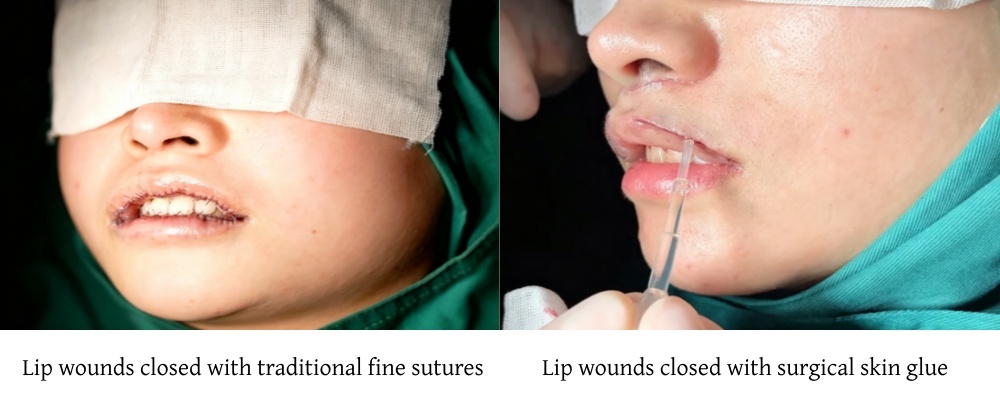 Lip wounds closed with traditional fine sutures VS Lip wounds closed with surgical skin glue
