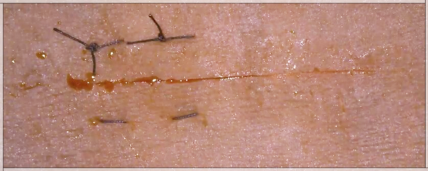 Horizontal Mattress Suture Technique Horizontal Mattress Suture Technique